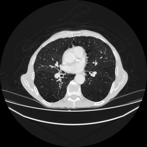 File:Cerebellar metastasis - lung tumor (Radiopaedia 69317-79150 Axial lung window 19).jpg