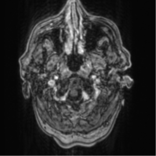 Cerebellar metastasis from lung adenocarcinoma (Radiopaedia 86690-102829 Axial T1 C+ 7).png