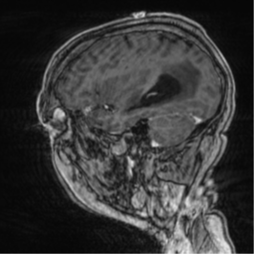 File:Cerebellar metastasis from lung adenocarcinoma (Radiopaedia 86690-102829 Sagittal T1 C+ 22).png
