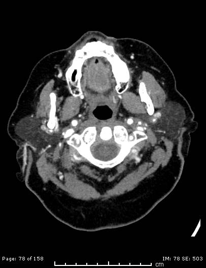 File:Cerebellar strokes due to intracranial giant cell arteritis (Radiopaedia 68799-78510 CT angiogram 78).jpg