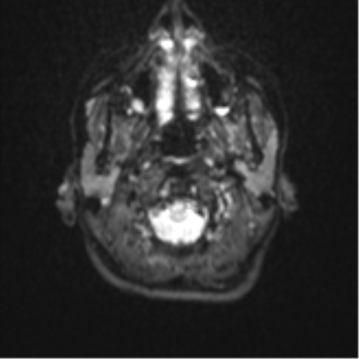 Cerebellar tuberculomas (Radiopaedia 46939-51472 Axial DWI 2).png