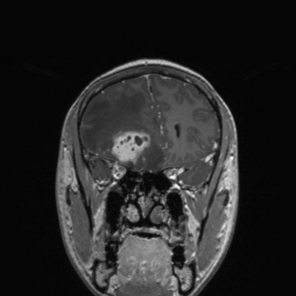 File:Cerebral abscess (Radiopaedia 24212-24478 Coronal T1 C+ 72).jpg