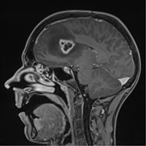 Cerebral abscess (Radiopaedia 60342-68009 J 32).png
