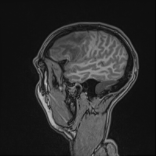 File:Cerebral abscess (Radiopaedia 60342-68009 Sagittal T1 46).png