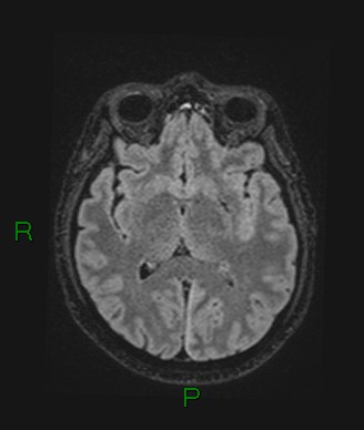 Cerebral abscess and subdural empyema (Radiopaedia 84436-99779 Axial FLAIR 44).jpg