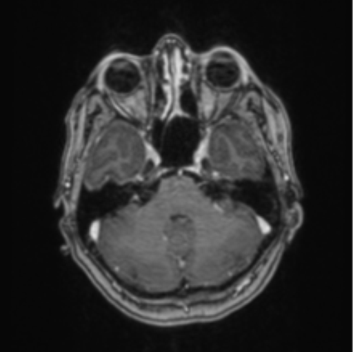 Cerebral abscess from pulmonary arteriovenous malformation (Radiopaedia 86275-102291 Axial T1 C+ 22).png