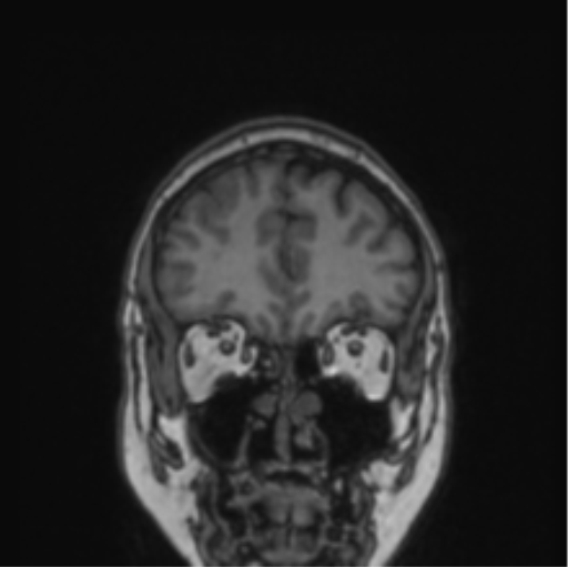 Cerebral abscess from pulmonary arteriovenous malformation (Radiopaedia 86275-102291 Coronal T1 71).png