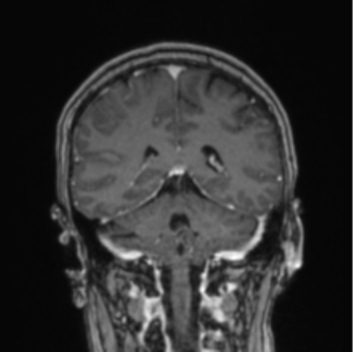Cerebral abscess from pulmonary arteriovenous malformation (Radiopaedia 86275-102291 L 34).png