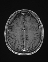 Cerebral amyloid angiopathy-related inflammation (Radiopaedia 58270-65377 Axial T1 C+ fat sat 106).jpg