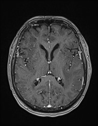 Cerebral amyloid angiopathy-related inflammation (Radiopaedia 58270-65377 Axial T1 C+ fat sat 76).jpg