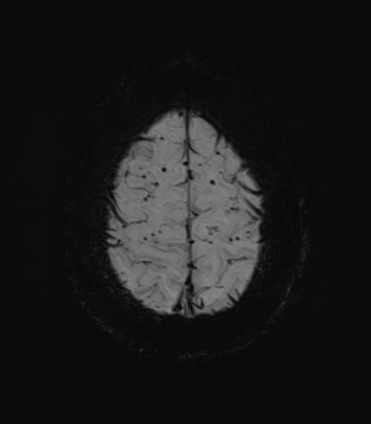 Cerebral amyloid angiopathy (Radiopaedia 46082-50433 Axial SWI MIP 70).png