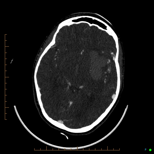 Cerebral arteriovenous malformation (AVM) (Radiopaedia 78162-90706 Axial CTA 133).jpg