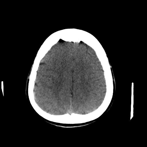 Cerebral arteriovenous malformation (Radiopaedia 28518-28759 Axial non-contrast 56).jpg