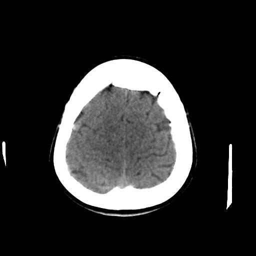 Cerebral arteriovenous malformation (Radiopaedia 28518-28759 Axial non-contrast 62).jpg