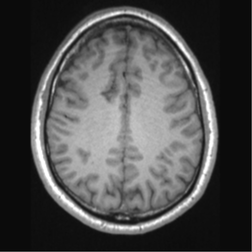 Cerebral arteriovenous malformation (Radiopaedia 39259-41506 Axial T1 53).png