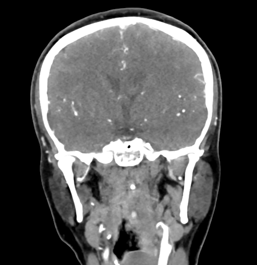 Cerebral arteriovenous malformation (Radiopaedia 73830-84645 C 48).jpg