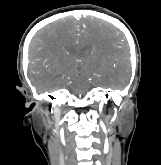 Cerebral arteriovenous malformation (Radiopaedia 73830-84645 C 53).jpg
