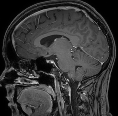 Cerebral arteriovenous malformation (Radiopaedia 74411-85654 Sagittal T1 C+ 61).jpg