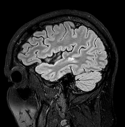 Cerebral arteriovenous malformation (Radiopaedia 74411-85746 Sagittal FLAIR 21).jpg