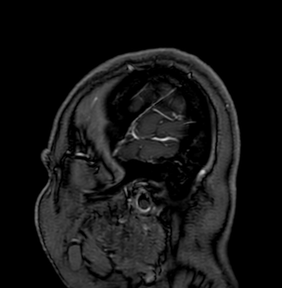 Cerebral arteriovenous malformation (Radiopaedia 74411-85746 Sagittal T1 C+ 4).jpg