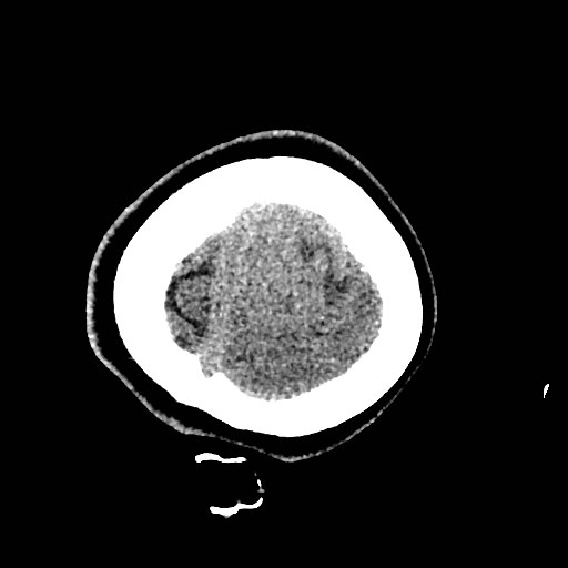 Cerebral arteriovenous malformation (Radiopaedia 79677-92887 Axial non-contrast 59).jpg