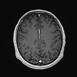 Cerebral arteriovenous malformation (Radiopaedia 84015-99245 Axial T1 C+ 110).jpg