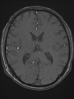 File:Cerebral arteriovenous malformation (Radiopaedia 84015-99245 Axial TOF 139).jpg