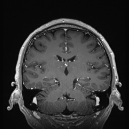 Cerebral arteriovenous malformation (Radiopaedia 84015-99245 Coronal T1 C+ 94).jpg