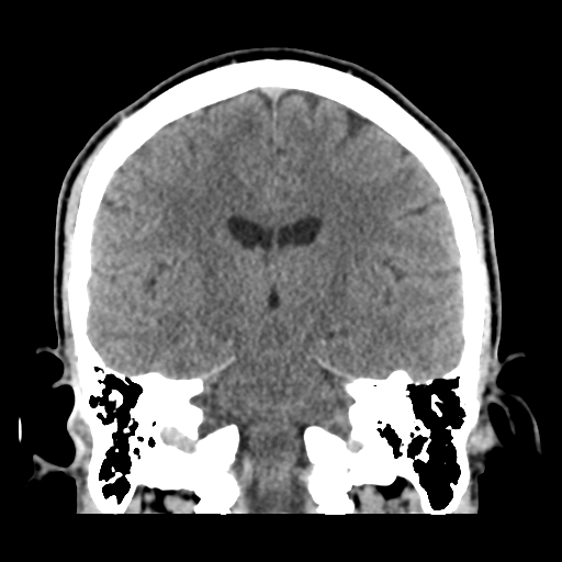 Cerebral arteriovenous malformation (Spetzler-Martin grade 2) (Radiopaedia 41262-44076 Coronal non-contrast 35).png