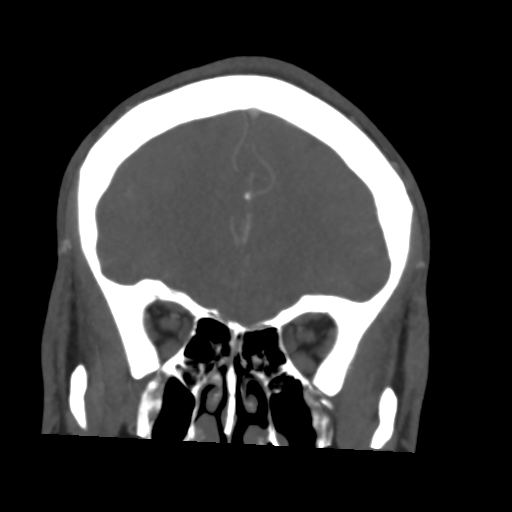 Cerebral arteriovenous malformation (Spetzler-Martin grade 2) (Radiopaedia 41262-44076 F 16).png