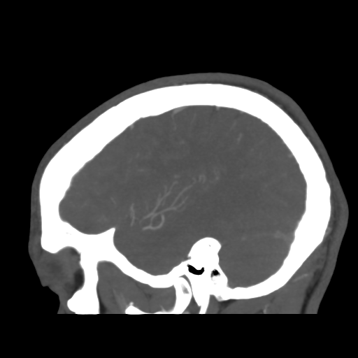 Cerebral arteriovenous malformation (Spetzler-Martin grade 2) (Radiopaedia 41262-44076 G 42).png