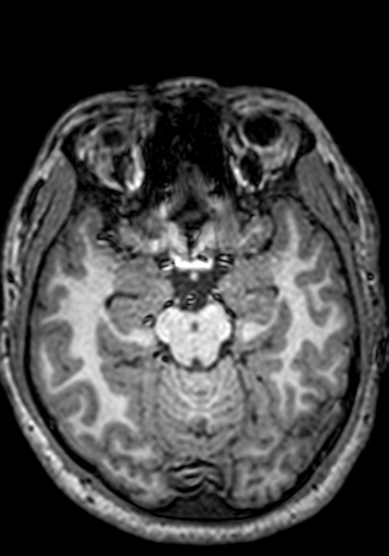 Cerebral arteriovenous malformation at posterior body of corpus callosum (Radiopaedia 74111-84925 Axial T1 195).jpg