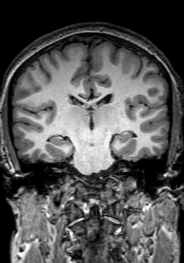 Cerebral arteriovenous malformation at posterior body of corpus callosum (Radiopaedia 74111-84925 Coronal T1 186).jpg