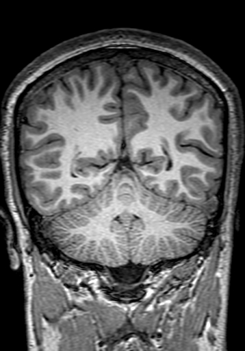 Cerebral arteriovenous malformation at posterior body of corpus callosum (Radiopaedia 74111-84925 Coronal T1 247).jpg