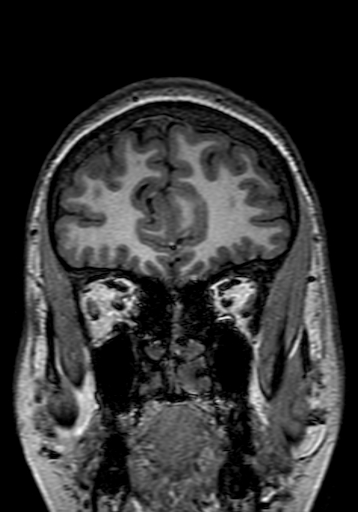Cerebral arteriovenous malformation at posterior body of corpus callosum (Radiopaedia 74111-84925 Coronal T1 47).jpg