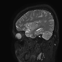 Cerebral arteriovenous malformation at posterior body of corpus callosum (Radiopaedia 74111-84925 Sagittal T2 105).jpg