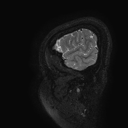 Cerebral arteriovenous malformation at posterior body of corpus callosum (Radiopaedia 74111-84925 Sagittal T2 131).jpg