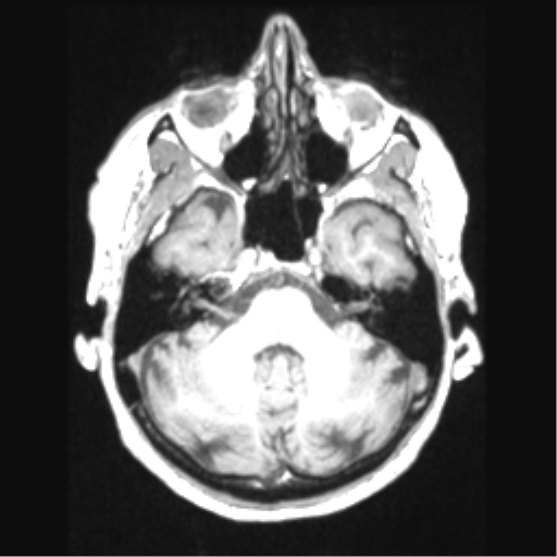 Cerebral arteriovenous malformation with hemorrhage (Radiopaedia 34422-35737 Axial T1 20).png