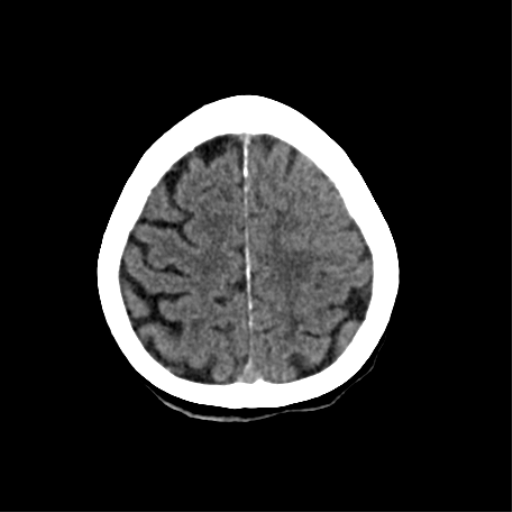 File:Cerebral arteriovenous malformation with lobar hemorrhage (Radiopaedia 44725-48510 Axial non-contrast 33).png