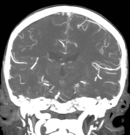 Cerebral arteriovenous malformation with lobar hemorrhage (Radiopaedia 44725-48511 B 32).png
