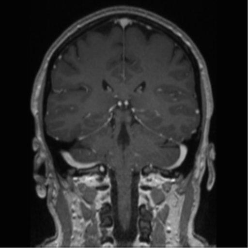Cerebral cavernoma and development venous anomaly (Radiopaedia 37603-39482 Coronal T1 C+ 39).png