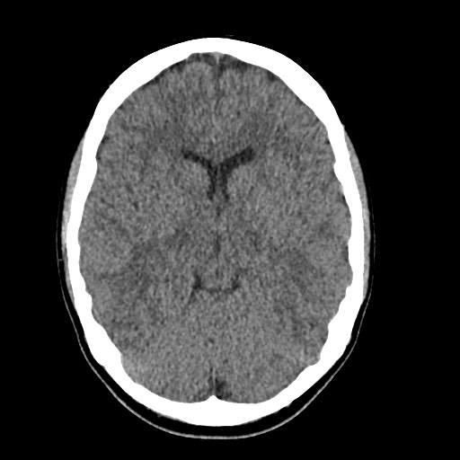 Cerebral cavernous venous malformation (Radiopaedia 70008-80022 Axial non-contrast 22).jpg