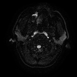 Cerebral cavernous venous malformation (Zabramski type II) (Radiopaedia 85511-101198 Axial DWI 2).jpg