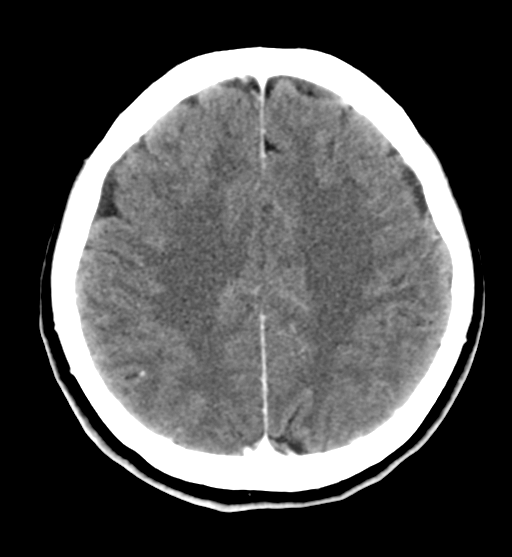 File:Cerebral cavernous venous malformations (Radiopaedia 48117-52945 Axial C+ delayed 24).png