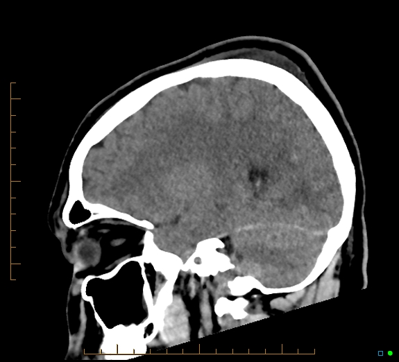 Cerebral fat embolism (Radiopaedia 85521-101224 C 18).jpg