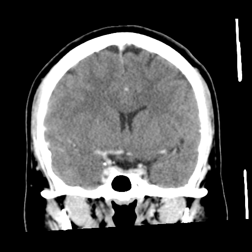 File:Cerebral hemorrhage secondary to arteriovenous malformation (Radiopaedia 33497-34561 C 28).png