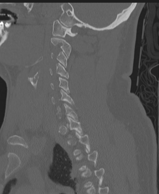 Cerebral hemorrhagic contusions and cervical spine fractures (Radiopaedia 32865-33841 Sagittal bone window 64).jpg