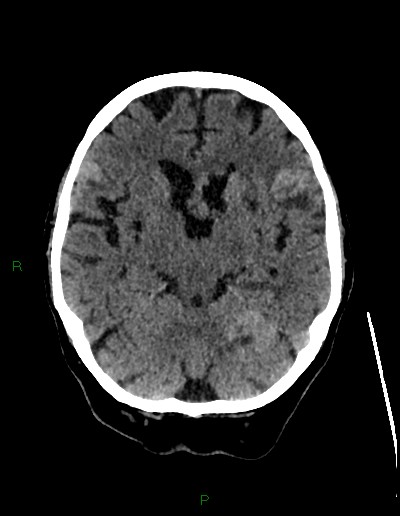 Cerebral metastases - ependymal and parenchymal (Radiopaedia 79877-93131 Axial non-contrast 29).jpg