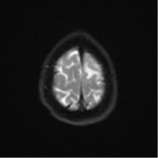Cerebral metastases mimicking abscesses (Radiopaedia 45841-50131 Axial DWI 26).png