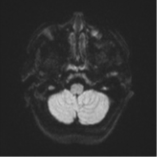 Cerebral metastases mimicking abscesses (Radiopaedia 45841-50131 Axial DWI 34).png